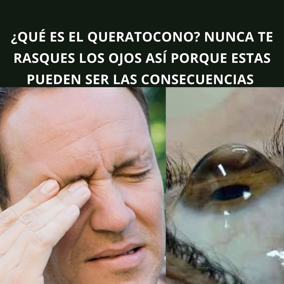 Síntomas de queratocono