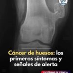 Los Primeros Síntomas del Cáncer de Huesos: Señales de Alerta que No Debes Ignorar