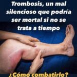 Trombosis: Un Mal Silencioso que Puede Ser Mortal ¿Conoces los Síntomas?