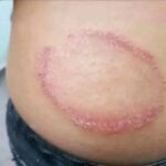 Signos y Remedios para las Erupciones Cutáneas