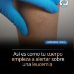 Señales de Alerta: Síntomas Característicos de la Leucemia