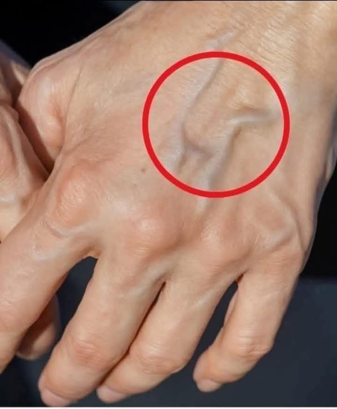 Vena visible en la mano