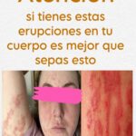 Herpes Zóster: Síntomas, Causas y Remedios Naturales