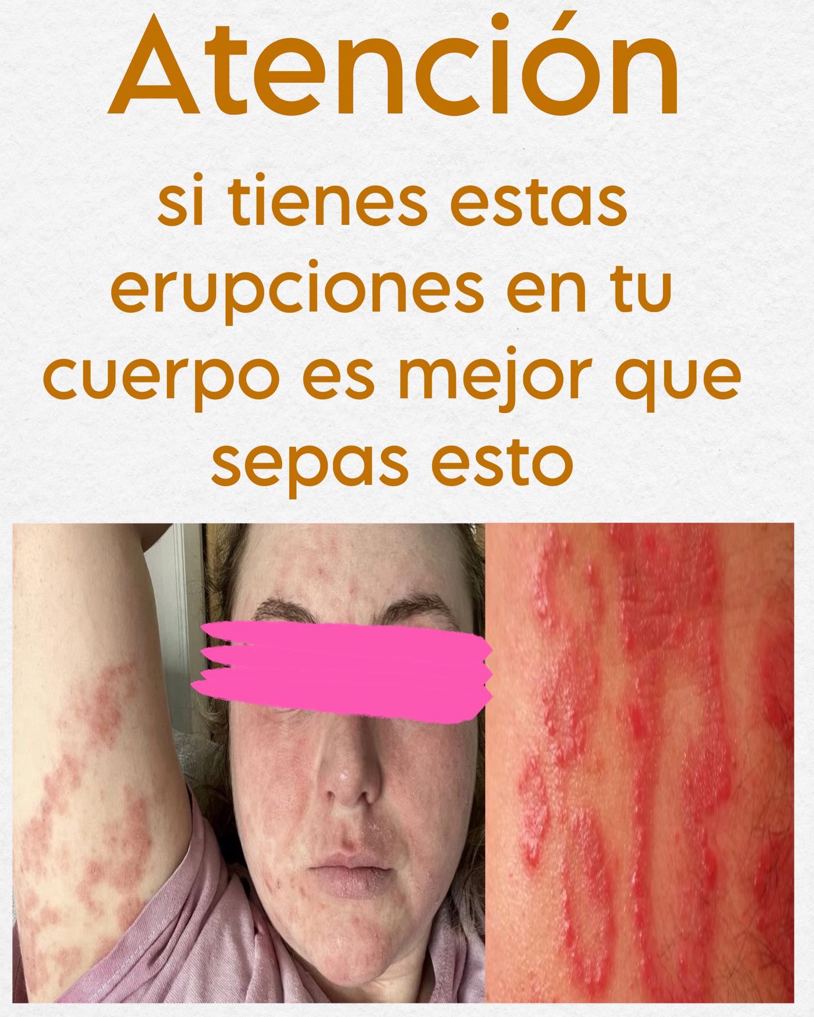 Erupciones cutáneas de herpes zóster