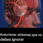 Aneurisma: Señales que No Debes Ignorar para Proteger tu Salud Cerebral