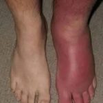 ¿Por qué se hinchan los pies? Causas, síntomas y remedios caseros