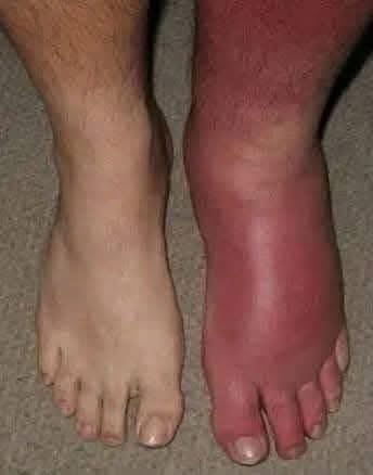 Pies hinchados