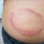 Signos de Tiña: Causas, Síntomas y Remedios Naturales Efectivos