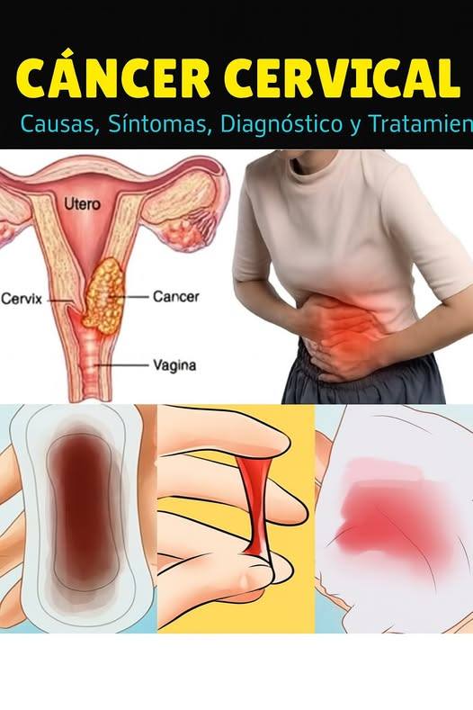 Diagrama del aparato reproductor femenino y señales de cáncer cervical