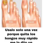 Rompe Hongos: La Solución Rápida para tus Uñas Afectadas