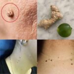 Elimina Verrugas de Manera Natural: Jengibre y Limón