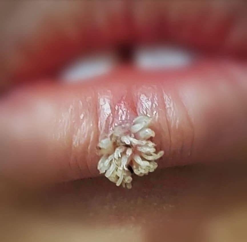Lesiones labiales