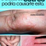 Cómo el Estrés Puede Afectar Tu Piel: El Eczema Dishidrótico