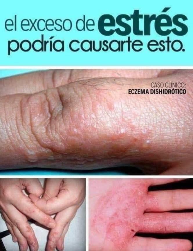Manos con eczema dishidrótico, mostrando irritación y síntomas como enrojecimiento y piel escamosa