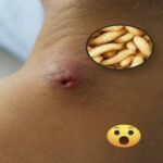Cuando el Acné se Confunde con Miasis: Entendiendo las Infecciones Cutáneas