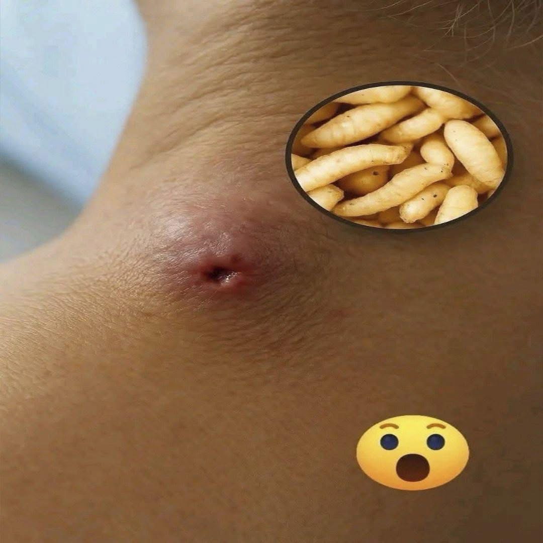 Infección cutánea por miasis