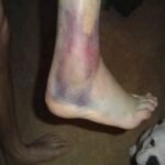 Consecuencias de Dormir con un Tobillo Hinchado: Tratamientos Naturales y Remedios Caseros