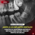 Revolucionando la Odontología: Cómo Creamos Dientes en Nuestras Encías