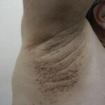 Conoce los Primeros Síntomas de Crecimientos en la Piel y Remedios Naturales