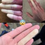 Todo lo que Necesitas Saber sobre el Fenómeno de Raynaud