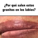 Granitos en los Labios: Causas y Remedios Caseros