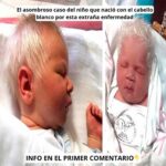 El Fascinante Caso del Niño que Nació con Cabello Blanco
