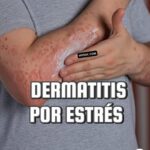 Dermatitis por Estrés: Cómo Reconocerla y Tratarla de Forma Natural