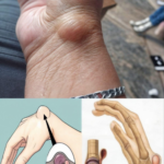 Entendiendo los Quistes de Ganglio: Causas y Remedios Naturales
