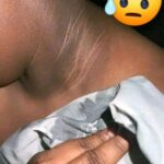 La Verdadera Causa del Cuello Negro: Descubre Cómo Tratarlo Naturalmente