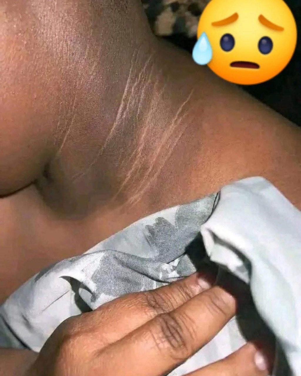 Condición de Piel Cuello Negro