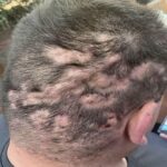 Remedios Naturales para la Alopecia: Cómo Combatir la Pérdida de Cabello