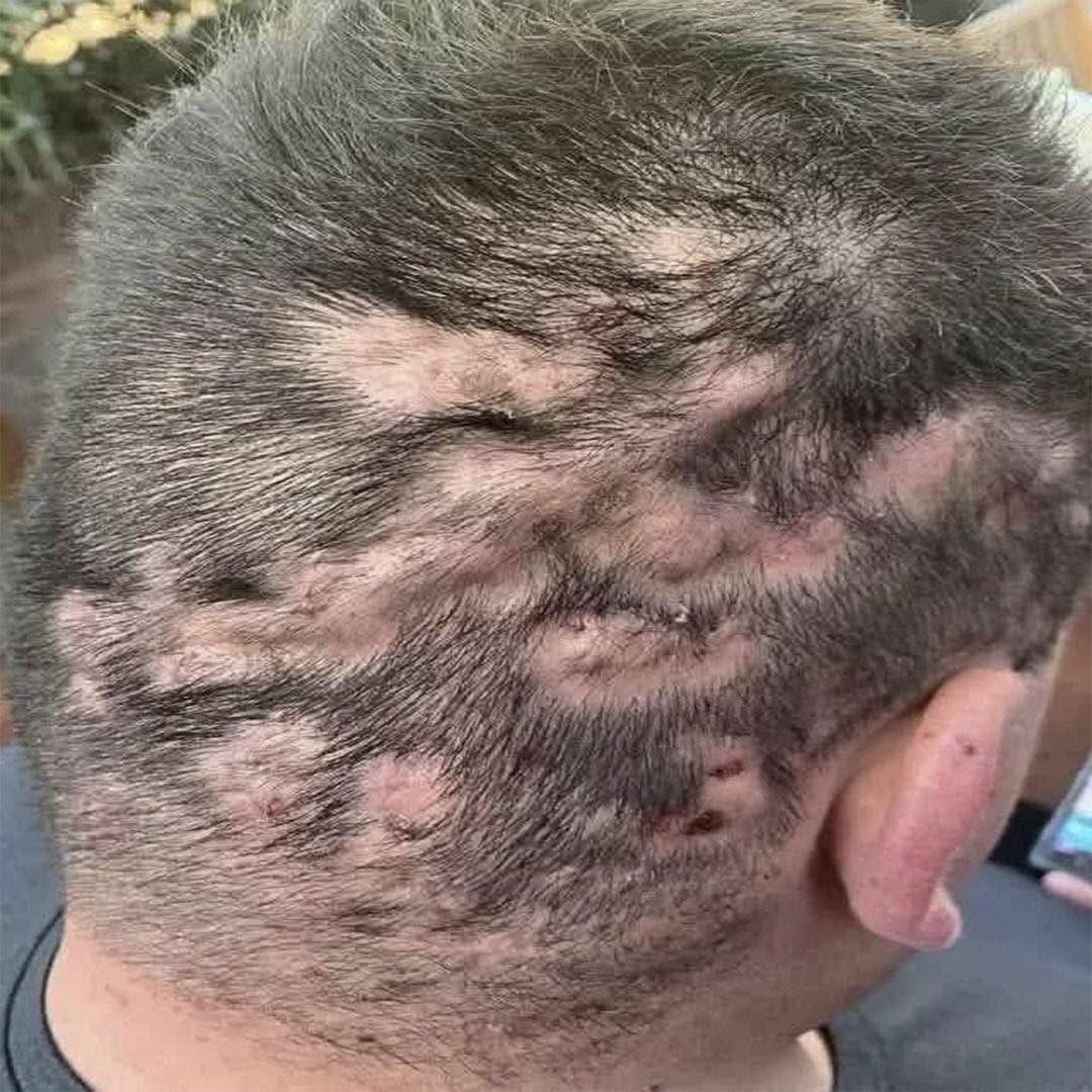Dermatología del cuero cabelludo