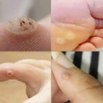 ¿Tienes Verrugas? Descubre los Remedios Naturales Más Eficaces