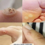 ¡Mucho Cuidado! Descubre si Tienes Verrugas – Causas y Remedios Naturales
