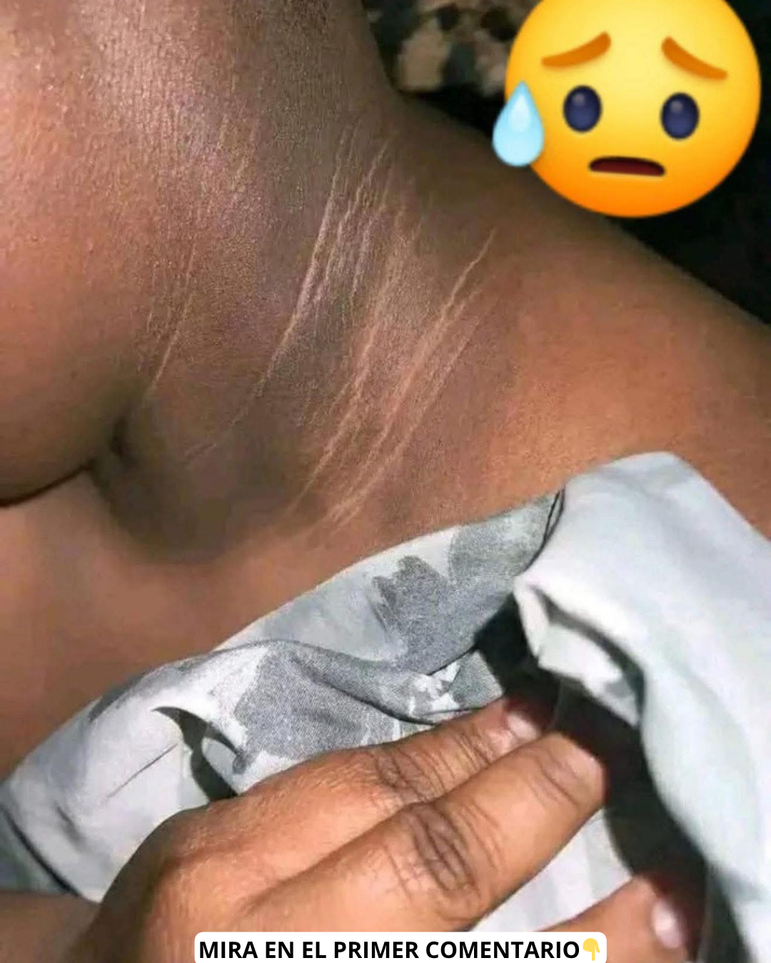 Cuello negro en la piel