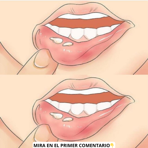 Remedios caseros para el herpes labial